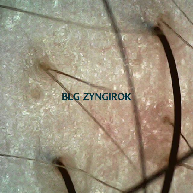 파나모아 복용 2주차 오른쪽 M자 부위 두피사진 모습이다.