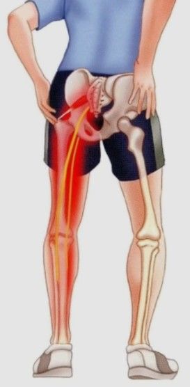 엉덩이 통증 증상