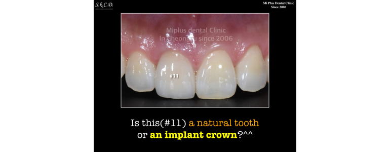 청주 청원구 틀니 병원