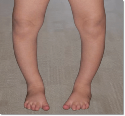 구루병에 좋은 대구간유