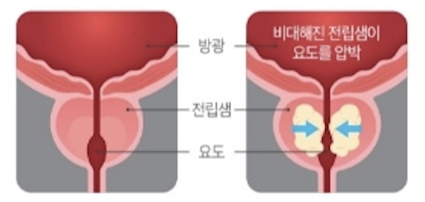 전립선