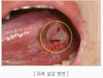 설암 침샘암 편도암 초기증상
