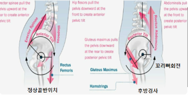 골반 후방회전 이미지