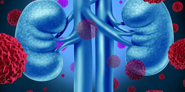 신장암과 관련된 사진