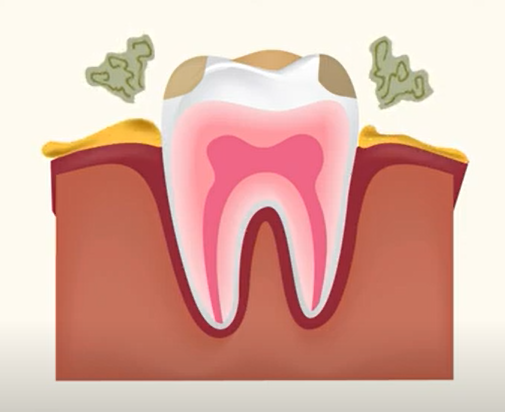  치주염의 원인 및 증상 