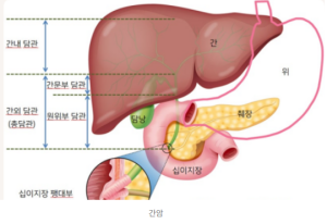 간암 치료 2년차 면역요법과 자연치료