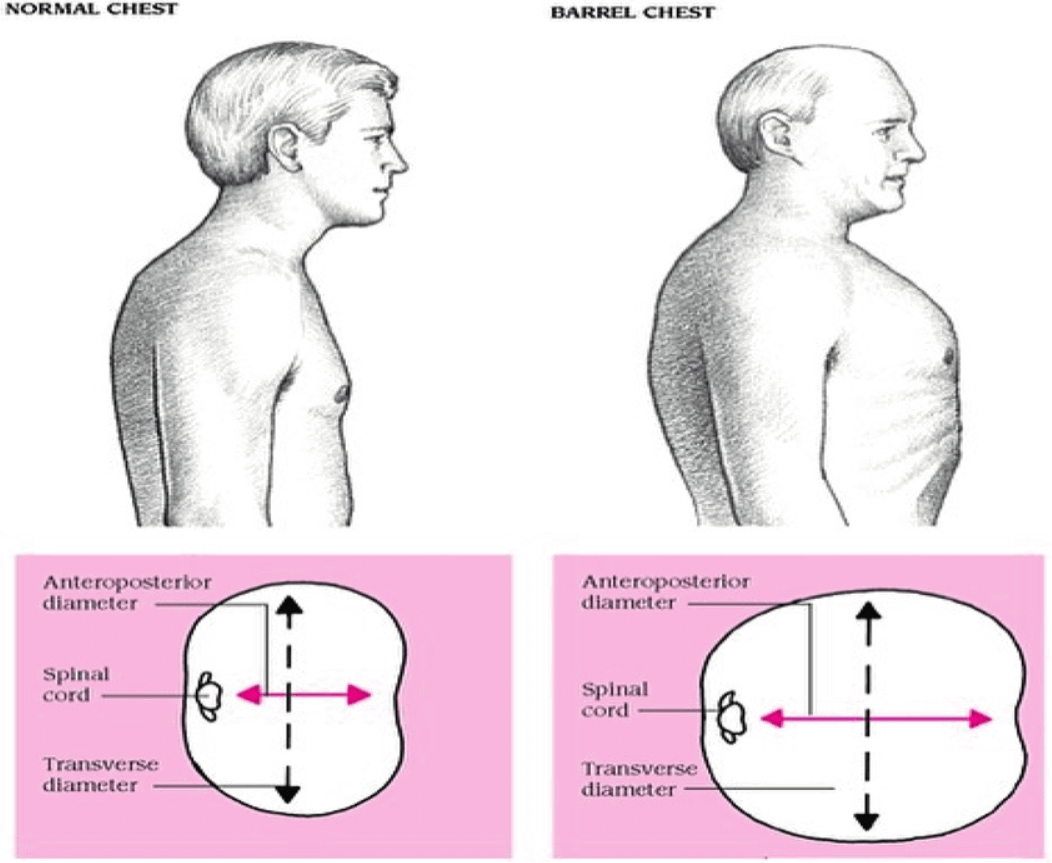 좌 : 정상 / 우 : 술통형 가슴