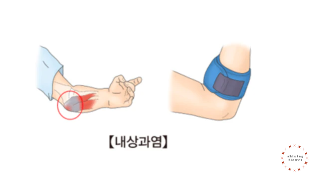 내상과염-서울아산병원 홈페이지 사진 참조
