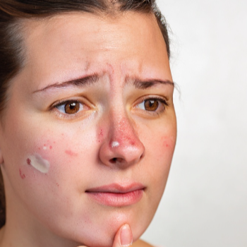 2. 홍역의 주요 증상 