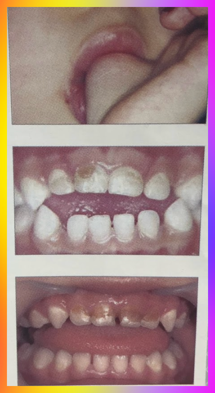 아기 치아 우식증 상태 모습