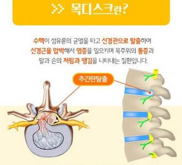 목 디스트란 어떤 것일까요?