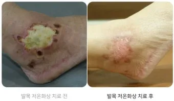 2도 화상 증상 자가치료 회복기간 응급처치법 정리_7