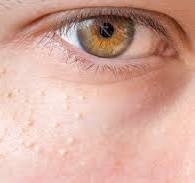 비립종 없애는 방법