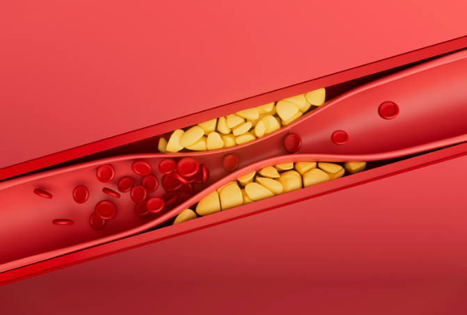 고지혈증의 위험성