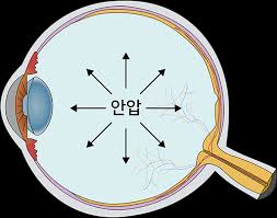 안압이 높을 때 증상