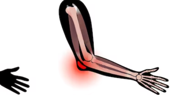 류마티스 관절염 치료법