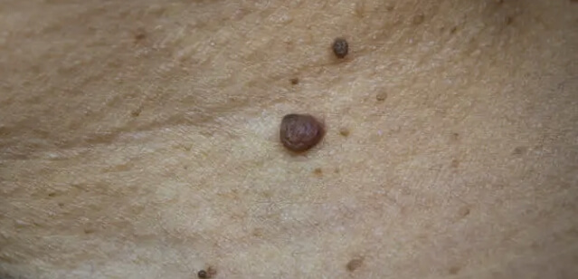 점, 편평사마귀, 쥐젖 제거방법과 가격, 제거후관리 총정리