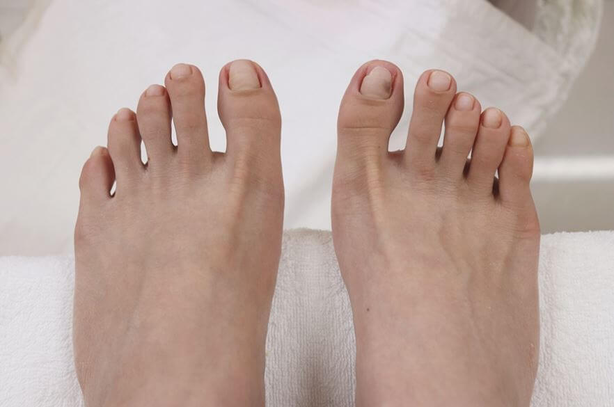 무좀이 다 나은 모습