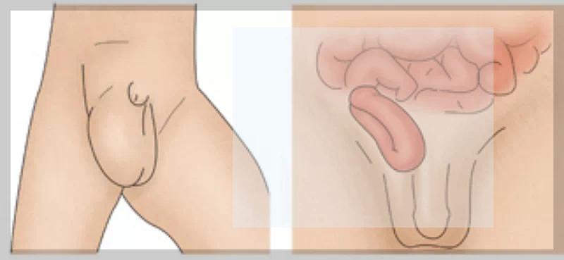 서혜부 탈장