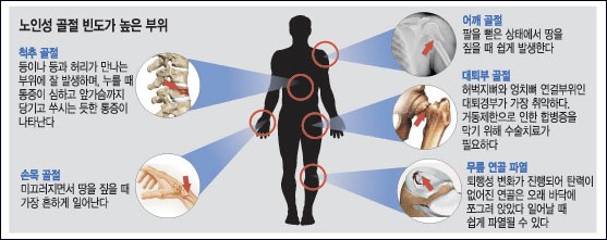 노인 골절부위 그림