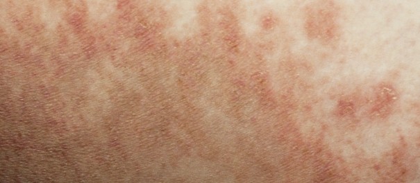 항문 습진 질환 가려움 관리 요령