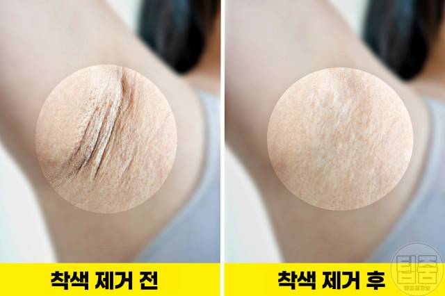 겨드랑이 착색 제거 겨드랑이 미백크림 추천