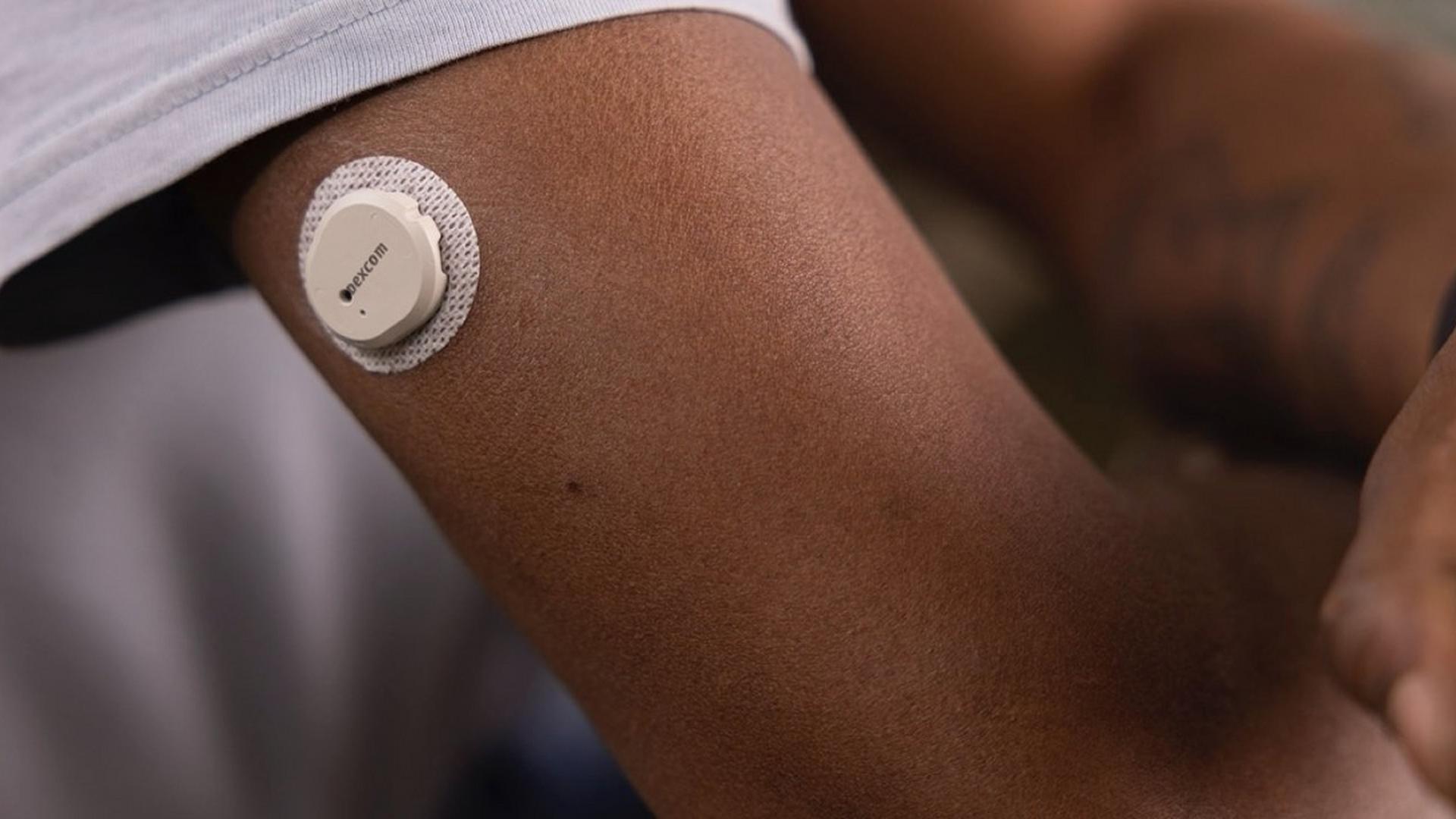 덱스콤 부착 모습