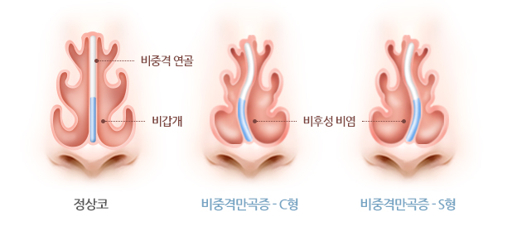 비중격 교정술 증상 및 진단 방법