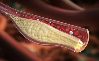 LDL 콜레스테롤 정상수치 낮추는법_4