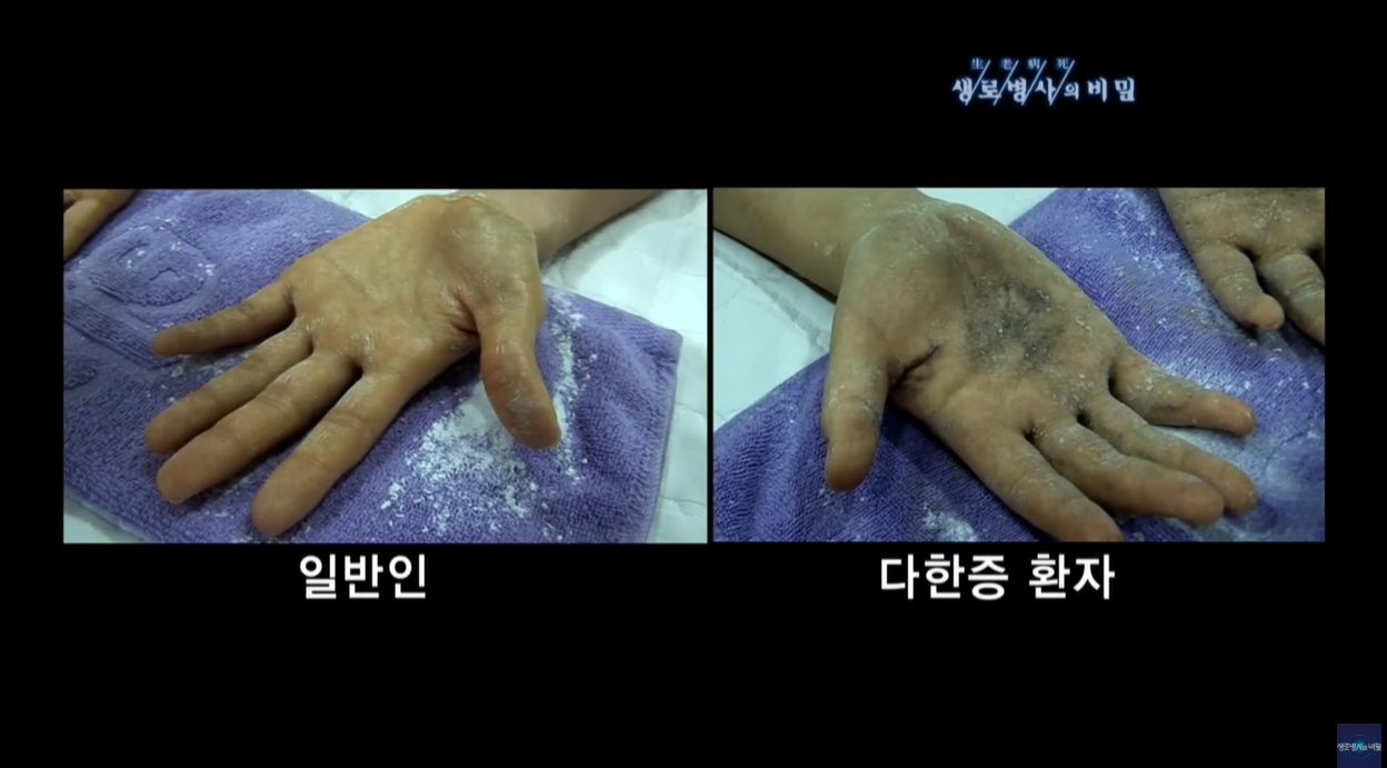 여름철피부건강 광알레르기 광민감성피부염 아토피 다한증 보상성다한증 액취증 콜린성두드러기 무좀