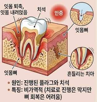 Gum disease and shaky teeth cause, pain intensity, cure summary