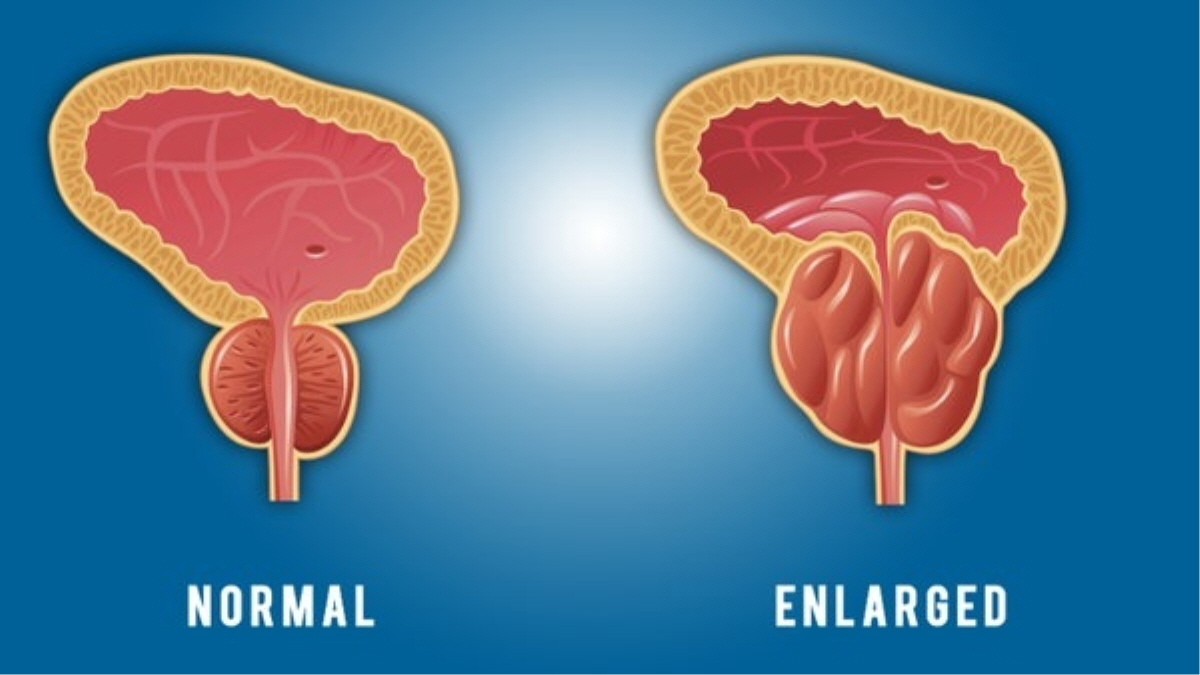 정상 전립선과 비대 전립선 비교 일러스트, 전립선 비대증 이해를 돕는 시각자료