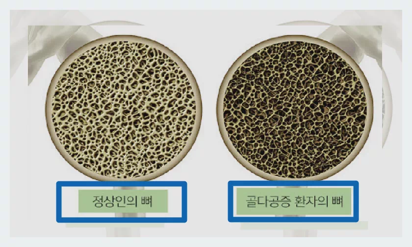 골다공증 뼈 비교