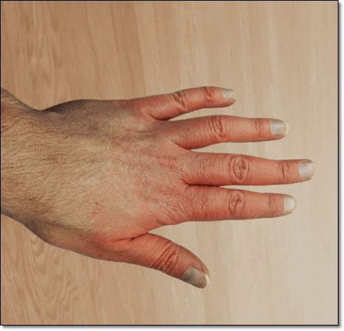 손가락 관절염 증상, 손가락 관절염으로 손가락이 변형된 여성