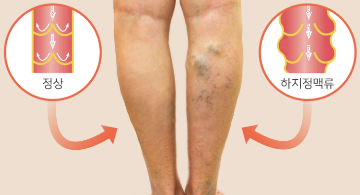 하지 정맥류 증상 12가지 총정리 섬네일
