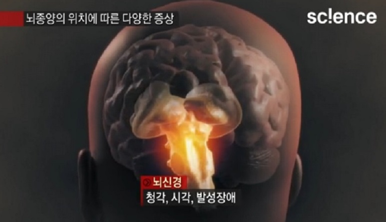 뇌종양위치에따른증상