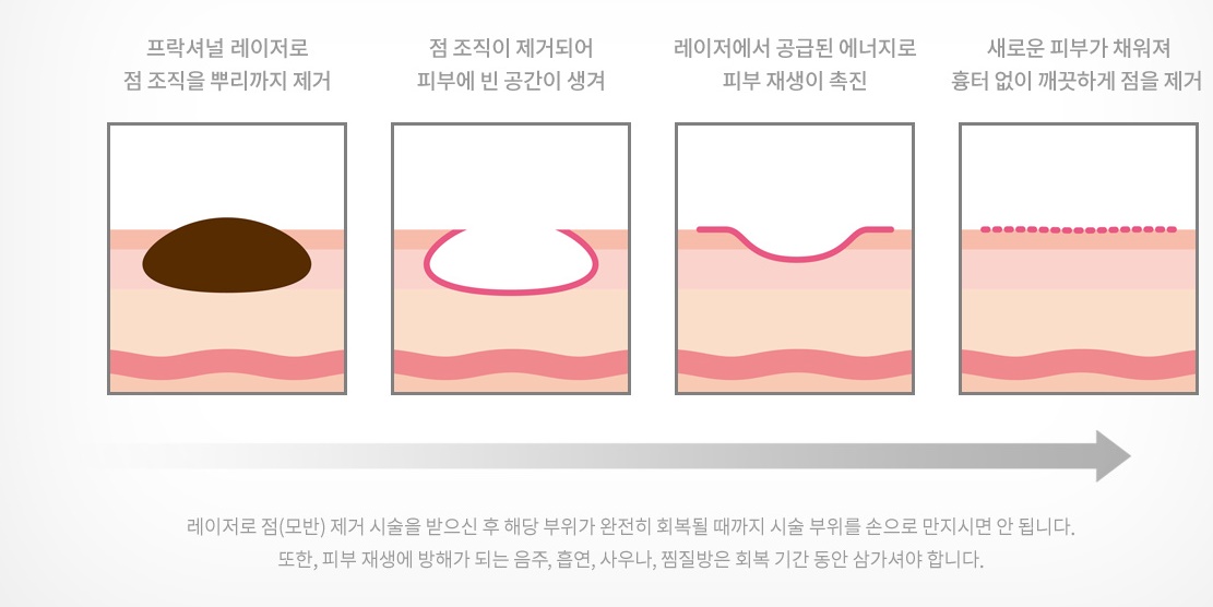 점제거하는 방식