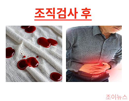 조직검사 시 추가로 주의해야 할 사항
