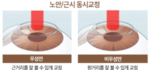 노안 검사
