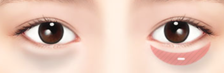 눈밑지방제거 수술비용과 수술효과