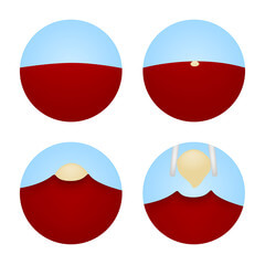 편도결석 빼는법, 집에서 빼는법 및 예방법을 알아봤습니다. 집에서 편도결석 빼는법과 병원에서는 편도결석을 어떻게 제거하는지 참고하시기 바랍니다.