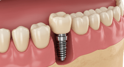 어금니 임플란트