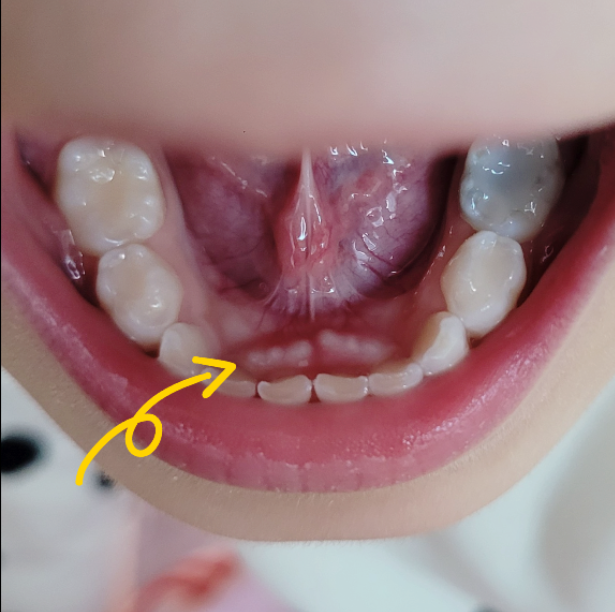 유치 나는 순서 시기, 유치 빠지는 순서 시기, 영구치 나는 순서 시기