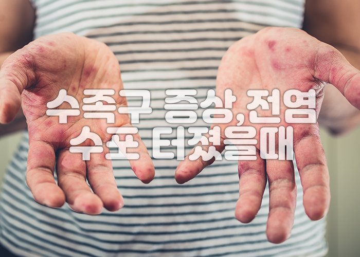 수족구로 인해 손에 발진이 돋아나 있다