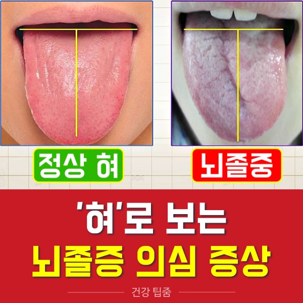 혀로 보는 뇌졸중 의심 초기증상 전조증상 뇌졸중 자가진단법, 혀 기울기, 혀 건강체크, 혀 건강상태, 건강 팁줌 매일꿀정보