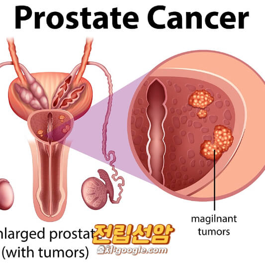전립선암