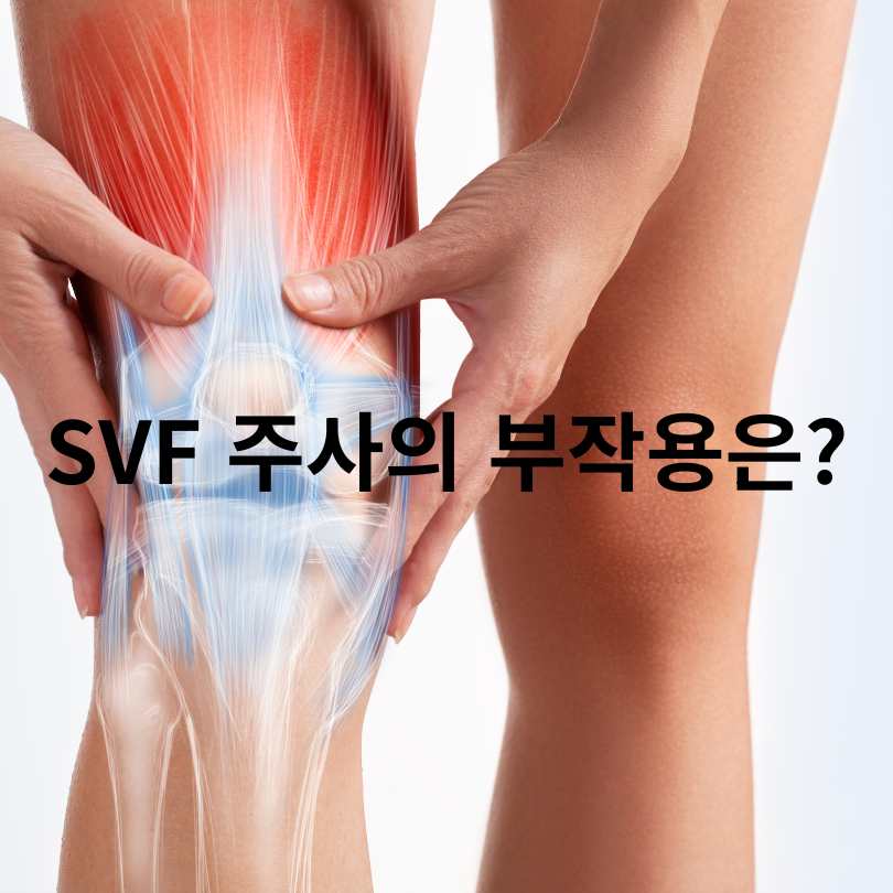 SVF 주사? 무릎 관절염 통증 줄이는 줄기세포 치료법 