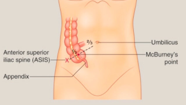 여자 맹장염 초기증상 02