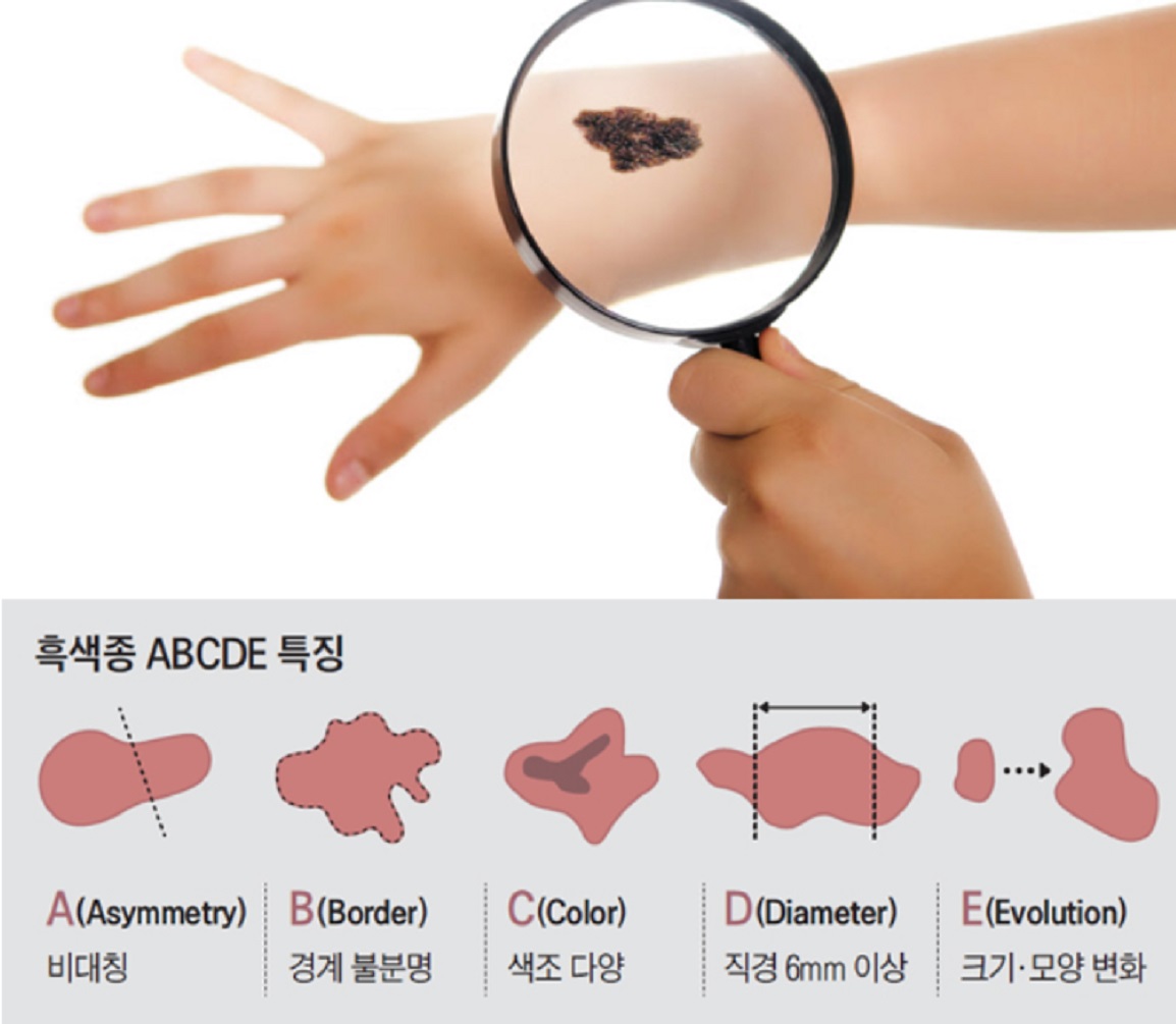 흑색종-피부과명의-오병호-교수