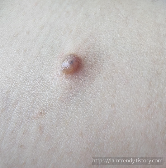 쥐젖 내동치료 1일차